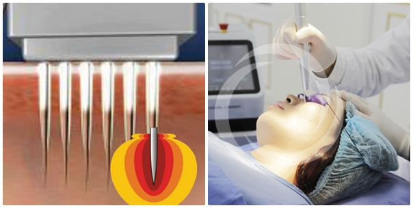 Cách trị mụn thịt ở mặt hiệu quả nhất với Laser siêu xung Cách trị mụn thịt ở mặt hiệu quả nhất với Laser siêu xung