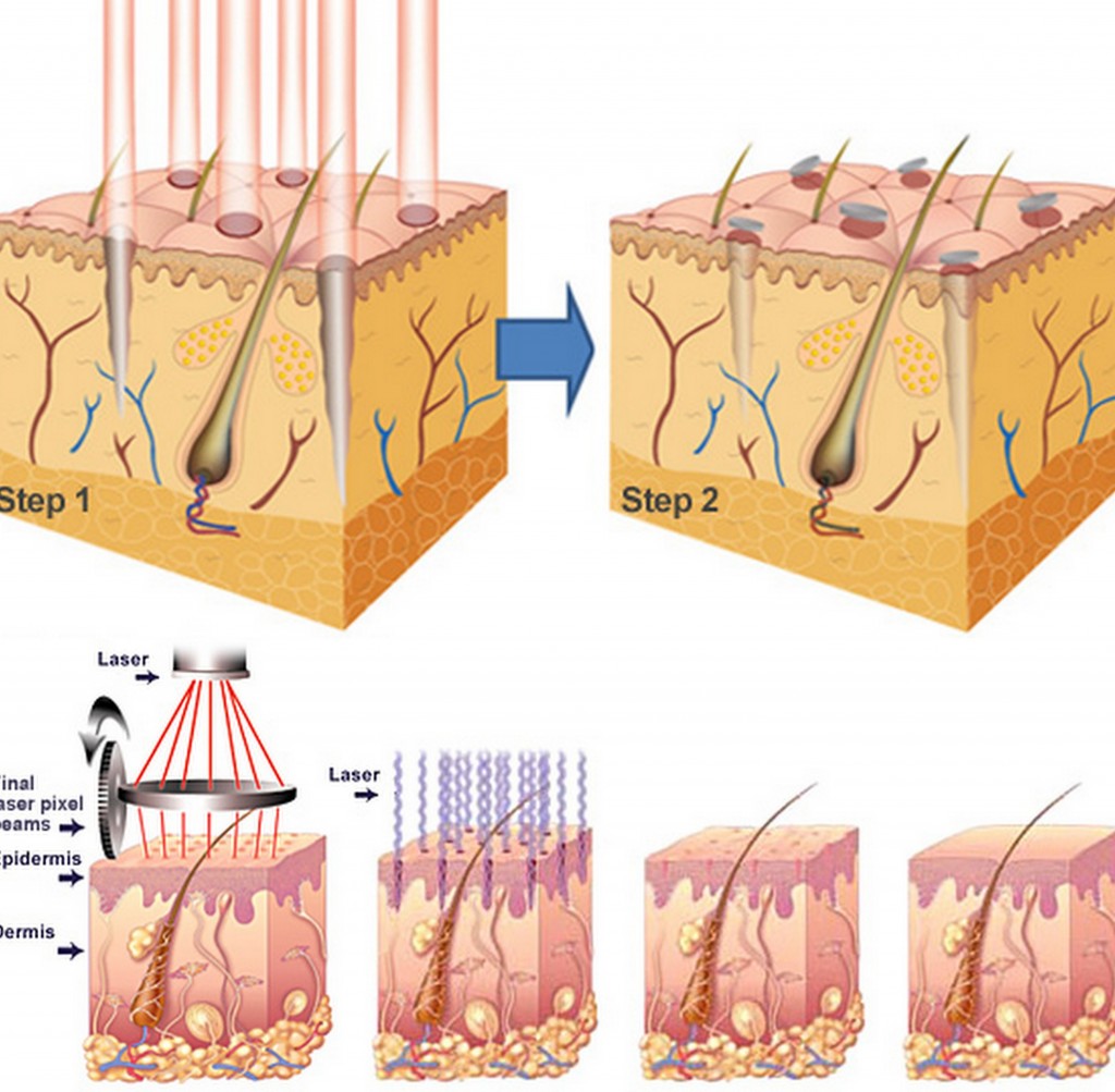 Laser thế hệ mới co-che-laser-sieu-xung - Copy