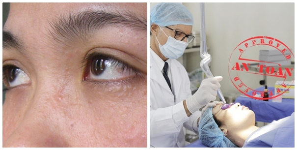 Công nghệ Laser siêu xung trị mụn thịt an toàn, không xâm lấn Công nghệ Laser siêu xung trị mụn thịt an toàn, không xâm lấn