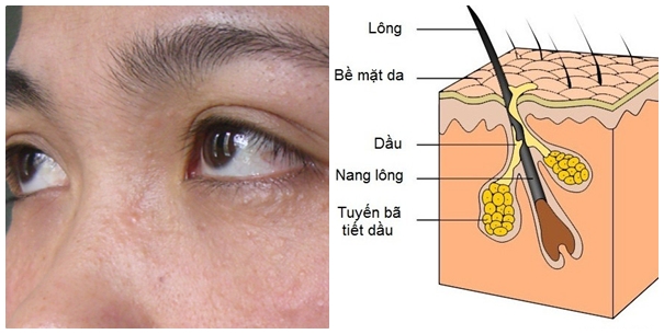 Nguyên nhân gây ra bệnh mụn thịt quanh mắt bắt nguồn từ u tuyến keo