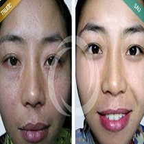 “Tôi đã trị khỏi mụn thịt nhờ Laser siêu xung để rạng ngời trong ngày cưới”