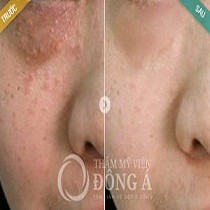 “Tôi đã tự tin theo đuổi ước mơ trở thành tiếp viên hàng không sau khi trị khỏi mụn thịt”