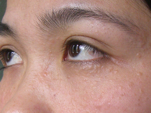 Phải làm sao chữa khỏi mụn thịt quanh mắt ?