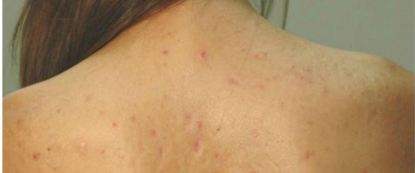 Lưng xuất hiện đầy các nốt mụn thịt (Hình ảnh minh họa) hành trình trị mụn thịt ở lưng